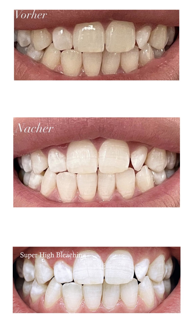 Dental Bleaching - Zähne aufhellen / bleichen Dental Bleaching - Zähne aufhellen / bleichen